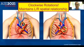 Echocardiography approach in patients with dextrocardia [upl. by Danelle509]