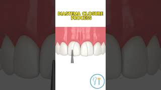 Diastema closure  How to close gap on front teeth with composite smile dentist teeth diastema [upl. by Annwahs]