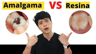 CUÁL ES EL MATERIAL A ELEGIR PARA CALZAR TUS DIENTES EMPASTES DENTALES AMALGAMA DENTAL VS RESINA [upl. by Haiasi921]