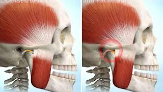 TMJ Anterior Disc Displacement [upl. by Sartin860]