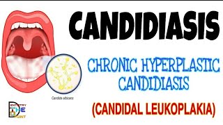 CANDIDIASIS  PRIMARY CHRONIC FORM  HYPERPLASTIC CANDIDIASIS OR CANDIDAL LEUKOPLAKIA [upl. by Enyehc]