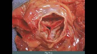 8 4 Valvular Disorders [upl. by Holds]