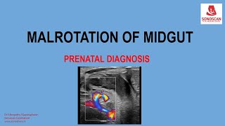 FETAL MALROTATION OF MIDGUT [upl. by Anal]