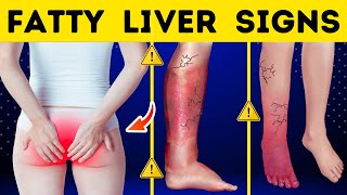 8 WARNING Signs You Have A FATTY LIVER  Fatty Liver Warning Signs [upl. by Shell]