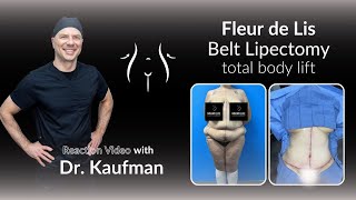 😱 JawDropping Fleur de Lis Belt Lipectomy Transformation 😍  Plastic Surgery Reaction🥹 [upl. by Kcam950]