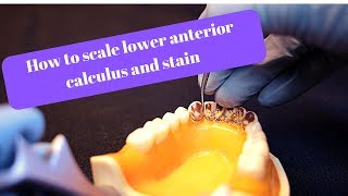 How to scale mandibular anterior calculus and stain [upl. by Aifoz]