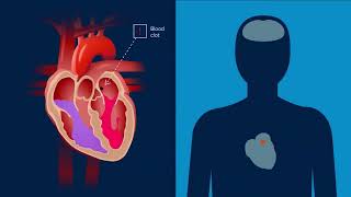 Medtronic Gunasekarans Cryoablation Journey [upl. by Rehm]