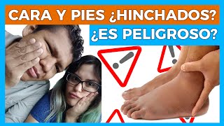 RETENCION DE LIQUIDOS 😱 PIESCARAMANOS HINCHADAS 🦶🏻🤚🏻💧Junica IRC [upl. by Reklaw681]