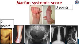 Differences in manifestations of Marfan Syndrome EhlersDanlos Syndrome and LoeysDietz Syndrome [upl. by Mw]