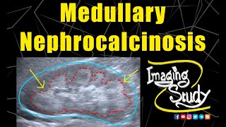 Medullary Nephrocalcinosis  Ultrasound  Case 128 [upl. by Imray]