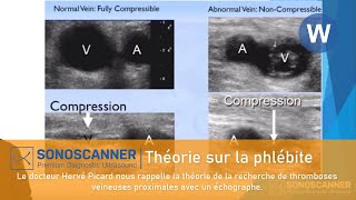 Dans cette courte vidéo le Dr Picard nous rappelle la théorie de la recherche de phlébite [upl. by Pardner]