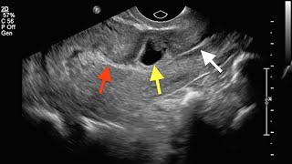 Non Tubal Ectopic Pregnancies [upl. by Kisor]