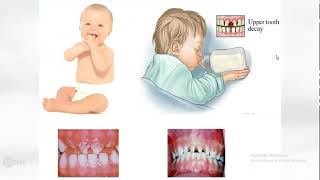 lecture 3 Dental caries with Dr omnya wahba clinical aspects  Classification of dental caries [upl. by Menken]