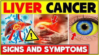 Early Signs And Symptoms Of Liver Cancer Dont Ignore These Symptoms  Liver Cancer Symptoms [upl. by Landrum]