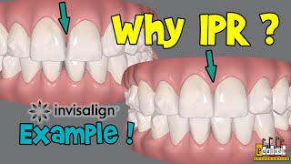 How does IPR or Interproximal Reduction with Invisalign help  Example Case [upl. by Annabal]