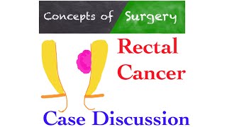 Rectal cancer case discussion and management algorithm [upl. by Sender]