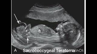 Ultrasound of Sacrococcygeal Teratoma Review from the book Requisites of Ultrasound [upl. by Goss]