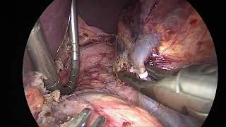 Laparoscopic adrenalectomy SwissMIS Berchtold [upl. by Feinstein]