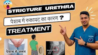 Urethral Stricture Symptoms Causes amp Treatment  Dr Venkatesh Kumar noida greaternoida [upl. by Merrel]