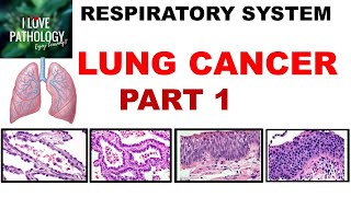 LUNG CANCER Part 1 Epidemiology Etiopathogenesis Precursor lesions amp Classification [upl. by Ribaudo282]