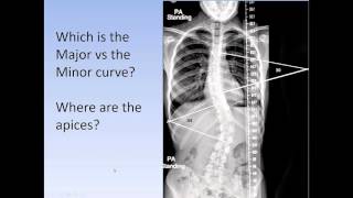 Scoliosis How to medically classify scoliosis the Lenke System for AIS [upl. by Aima]