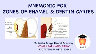 MNEMONIC FOR ZONES OF ENAMEL AND DENTIN CARIES  DR NISHA GARGS DENTAL ACADEMY  NEET 2022 [upl. by Aniela]