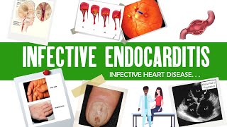 Infective Endocarditis  Dukes criteria  definition causes symptoms complications amp treatment [upl. by Drazze]