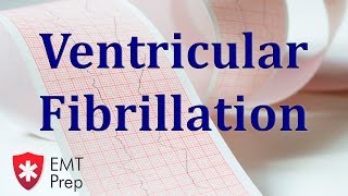 Ventricular Fibrillation ECG  EMTprepcom [upl. by Eimmas]