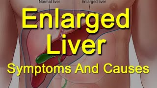 Enlarged Liver Symptoms And Causes  What Is Hepatomegaly [upl. by Zinah]