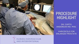 Florida Endovascular amp Interventional  Procedure Highlight 5 Varicocele Embolization [upl. by Osborne370]