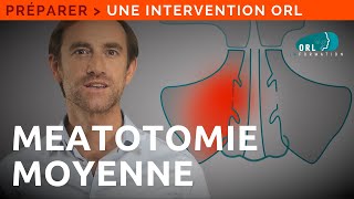 Information Patient  Chirurgie du nez ouverture des sinus maxillaires [upl. by Olds662]