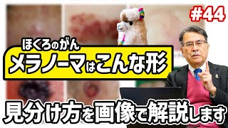 第44話 【ほくろのがんメラノーマはこんな形！】見分け方を画像で解説します [upl. by Ynotna]