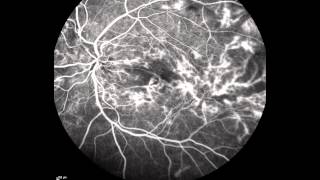 Proliferative Diabetic Retinopathy [upl. by Rame]