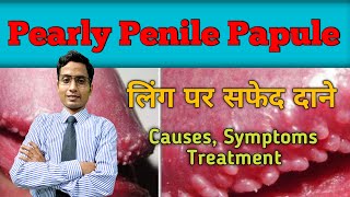 Pearly penile papuleलिंग पर सफेद दाने [upl. by Neraa713]