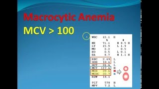 Hematology 2 Macrocytic Anemia [upl. by Meingolda]