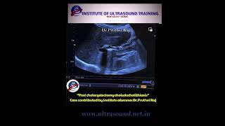 choledocholithiasis postcholecystectomy drrandhawainstitute ultrasound ultrasoundtraining [upl. by Seldon]