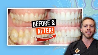 Braces Overbite Treatment BEFORE amp AFTER [upl. by Guyer]