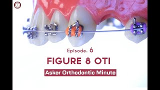 Figure 8 Oti Asker Orthodontic Minute Episode 6 [upl. by Ahsinet]