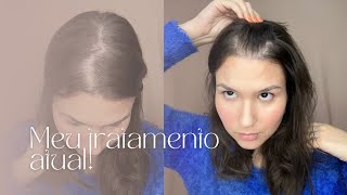 ALOPECIA ANDROGENÉTICA Meu tratamento atual  Junho 2023 [upl. by Eilarol]