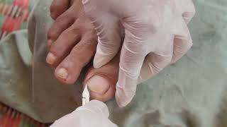 Removing Deep Ingrown Toenail [upl. by Nishom214]