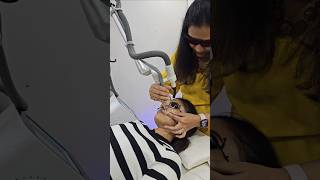 Laser Treatment for Acne Scars  acne shorts [upl. by Aicilehp97]