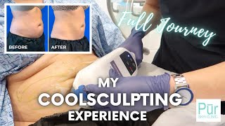 My COOLSCULPTING EXPERIENCE  Full Journey  COOLSCULPTING BEFORE AND AFTER Photos  Pūr Skin Clinic [upl. by Herwig]