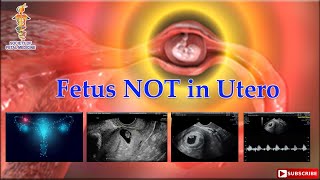 Fetus NOT in Utero [upl. by Colin]