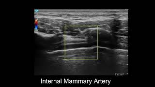 Internal Mammary Artery On Ultrasound [upl. by Nner977]