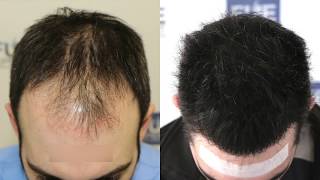 FUE Hair Transplant 3467  1000 grafts in NW  Class IV  A Dr Juan Couto  FUEXPERT CLINIC [upl. by Zaneski]