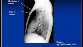 Chest Xray Lateral view [upl. by Tombaugh45]