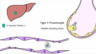 Bacterial Pneumonia  Pathogenesis [upl. by Laroc]