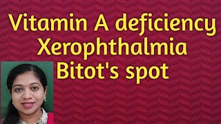 Xerophthalmia Vitamin A deficiency Bitots spot [upl. by Damalas]