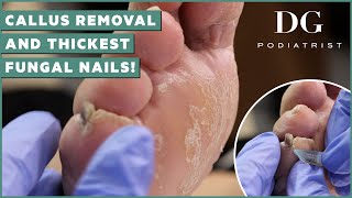 Callus removal from feet and thick toenails cutting treatment  DG Podiatrist The Foot Scraper [upl. by Eemyaj971]