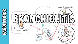 Bronchiolitis causes pathophysiology signs and symptoms treatment [upl. by Debbra879]